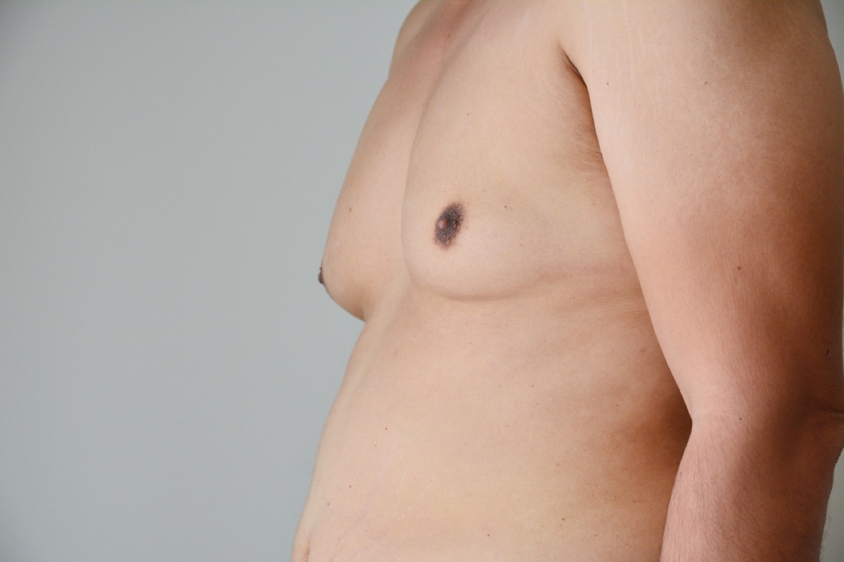 man with breast tissue and belly, subtle symptoms of serious disease