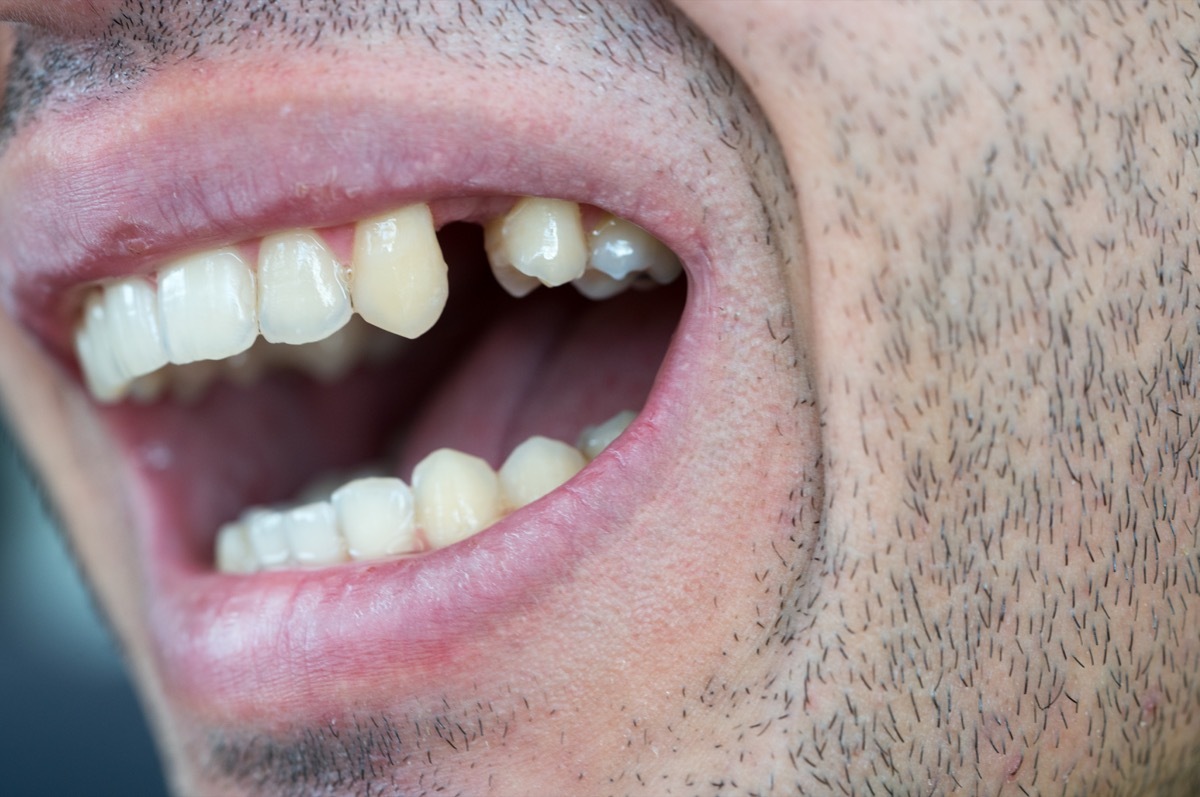 Man Missing Tooth