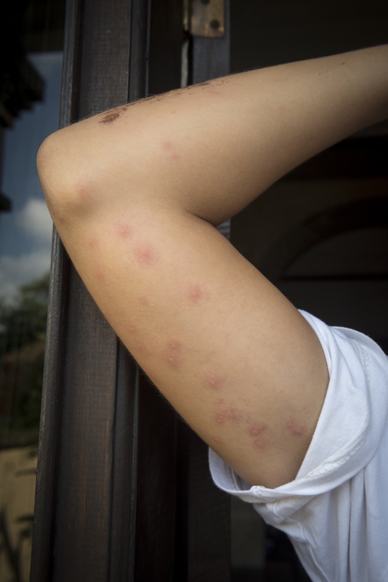 Bed bug bites on woman