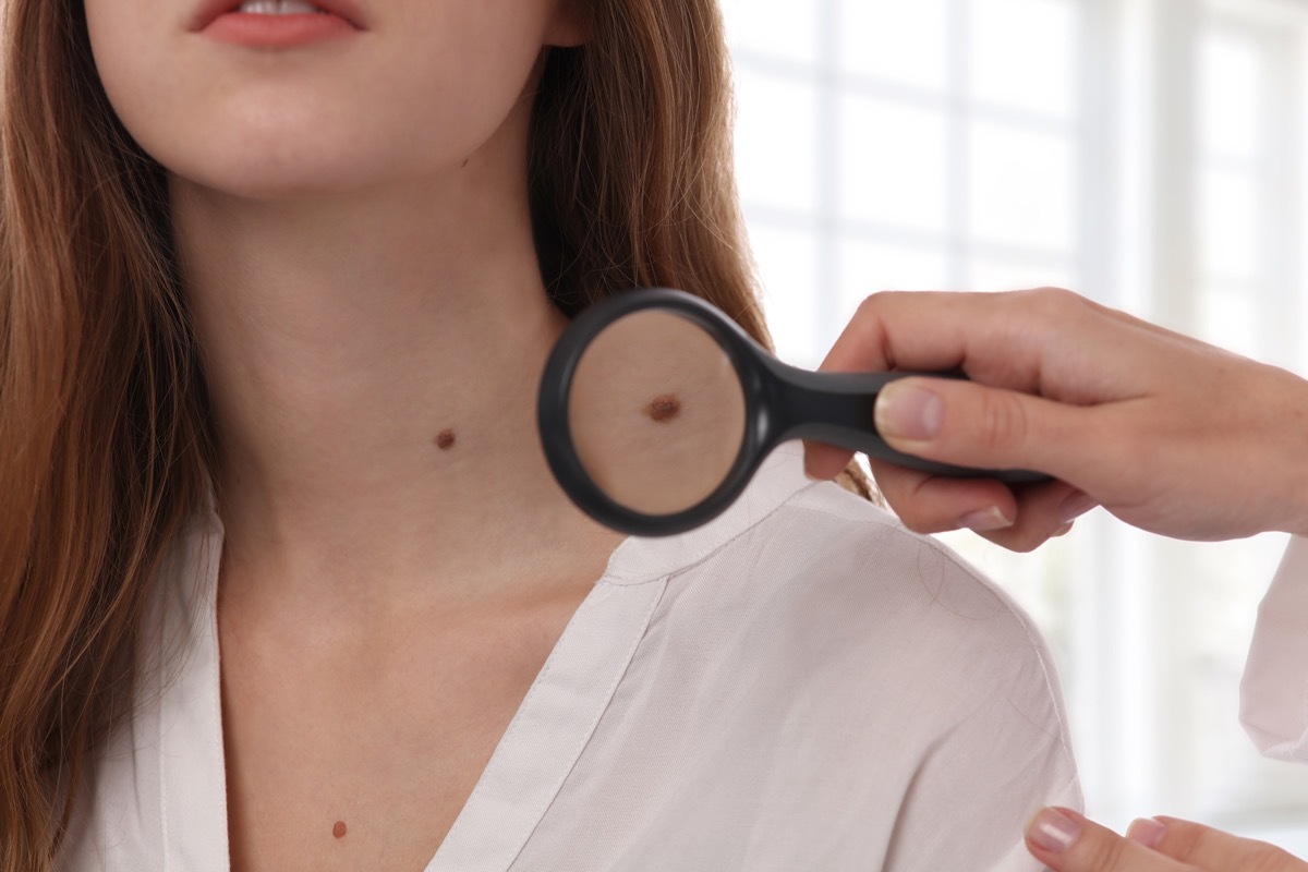 Woman getting her mole checked