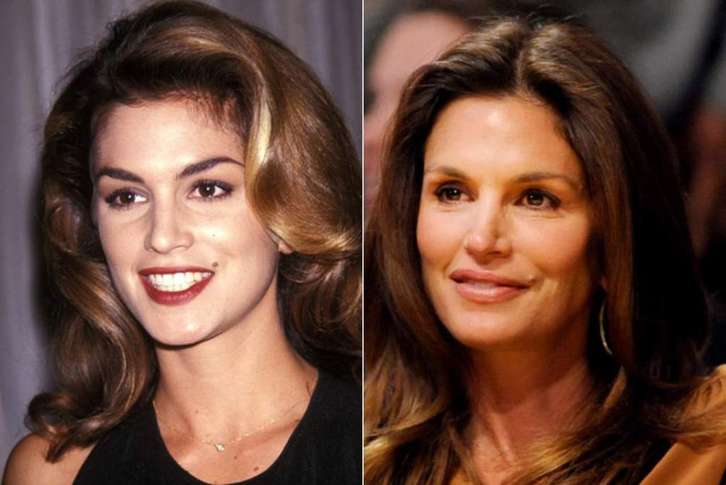 gorgeous-stars-before-and-after-botox-06