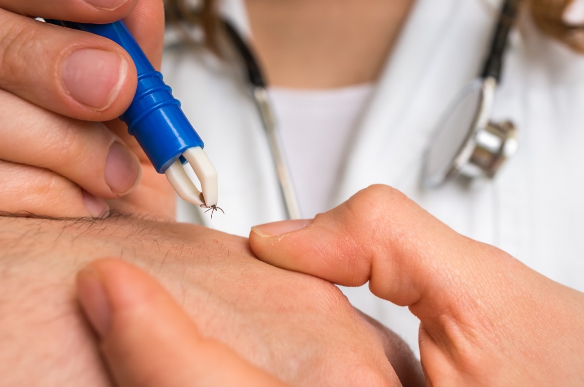 Female doctor removing a tick with tweezers from hand of patient. Encephalitis, borreliosis and lyme disease.